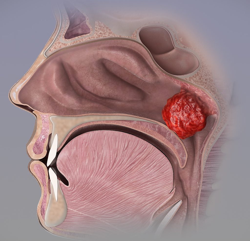 Criança com adenoide aumentada recebendo avaliação médica para possível cirurgia