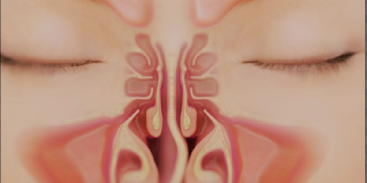 Ilustração de cirurgia de desvio de septo com foco na correção do septo nasal para melhorar a respiração.