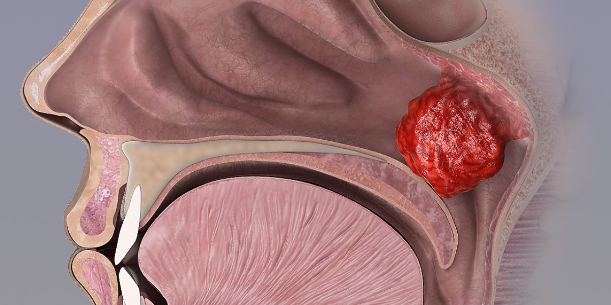 Criança com adenoide aumentada recebendo avaliação médica para possível cirurgia
